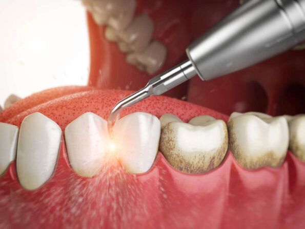 Limpieza Dental